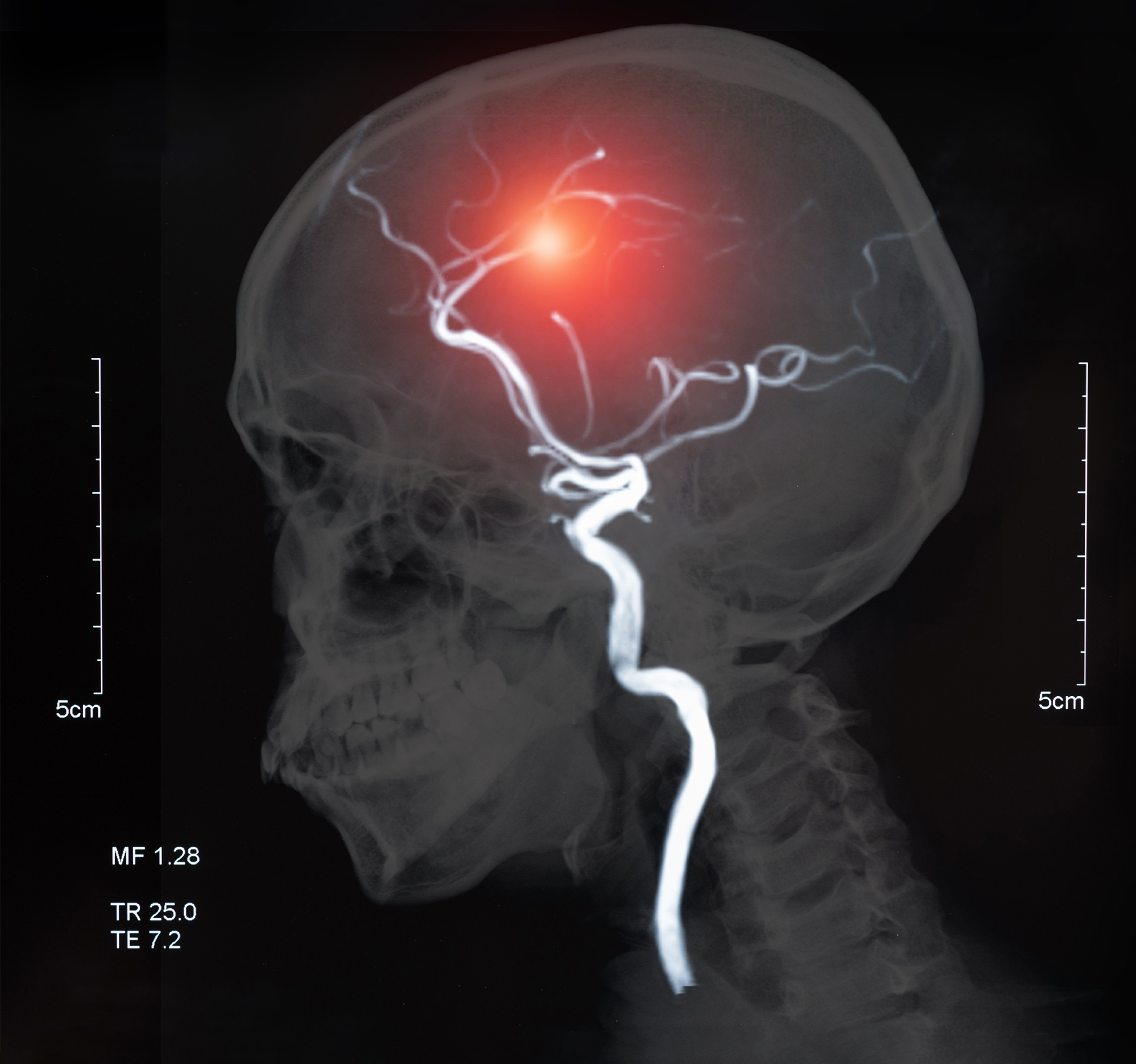 Cerebral angiogram showing stroke